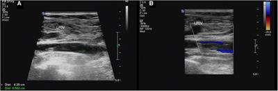Case Report: Imaging features of a new type double inferior vena cava malformation and review